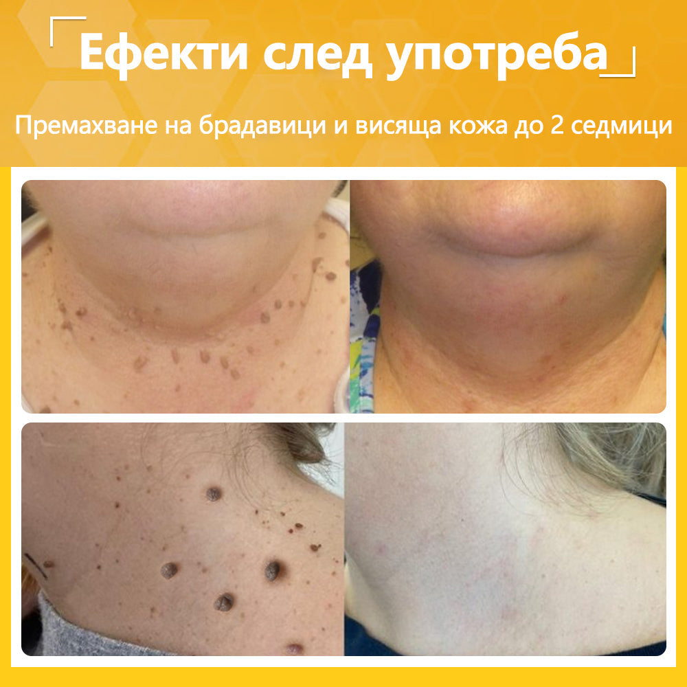 🍋‍🟩✅Dormorna® Силен ефект Крем с пчелен отрова – ✨Препоръчван от експерти по дерматология. Ефективен срещу брадавици, издутини, лезии, инфекции и белези.🐝🐝