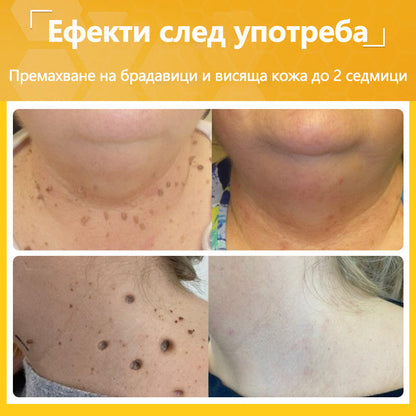 🍋‍🟩✅Dormorna® Силен ефект Крем с пчелен отрова – ✨Препоръчван от експерти по дерматология. Ефективен срещу брадавици, издутини, лезии, инфекции и белези.🐝🐝