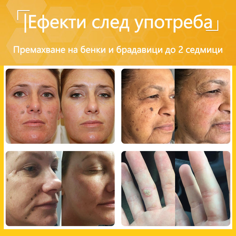 🍋‍🟩✅Dormorna® Силен ефект Крем с пчелен отрова – ✨Препоръчван от експерти по дерматология. Ефективен срещу брадавици, издутини, лезии, инфекции и белези.🐝🐝