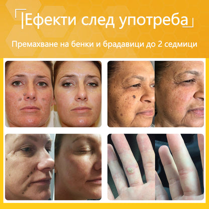 🍋‍🟩✅Dormorna® Силен ефект Крем с пчелен отрова – ✨Препоръчван от експерти по дерматология. Ефективен срещу брадавици, издутини, лезии, инфекции и белези.🐝🐝